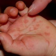 ТЕРМІНОВО ОГЛЯНЬТЕ СВОЮ ДИТИНУ! В дитячих садках поширюється страшний вірус, від якого в Україні немає вакцини
