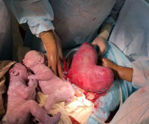 «Справжнє диво»: жінка з унікальною «маткою-серцем» народила близнюків (фото 18+)
