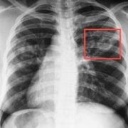 Перебіг більшості випадків туберкульозу є безсимптомним — лікар-фтизіатр Дмитро Пронь