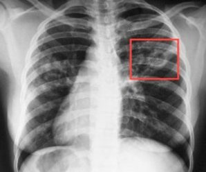 Перебіг більшості випадків туберкульозу є безсимптомним — лікар-фтизіатр Дмитро Пронь