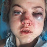 У 19-річної дівчини численні переломи кісток обличчя: вчора біля Стрия вона потрапила у ДТП (ФОТО 18+)