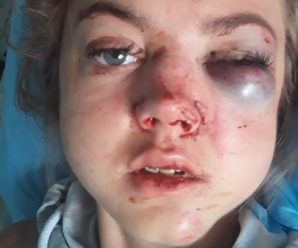 У 19-річної дівчини численні переломи кісток обличчя: вчора біля Стрия вона потрапила у ДТП (ФОТО 18+)