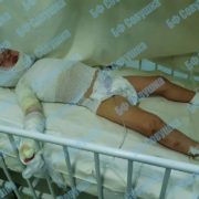 Руки без шкіри, голова та груди спечені: 2-річну дитину рятують від страшних опіків в реанімації (фото)