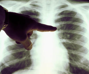 Медики фіксують перші випадки безсимптомного двобічного запалення легень