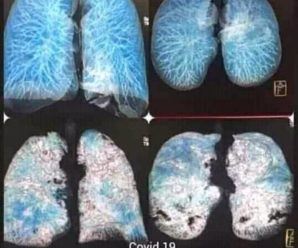 Медики показали, як виглядають уражені коронавірусом легені