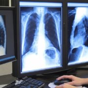 «Ковідна» лікарня у Калуші отримає корейський рентген-апарат вартістю майже 2 мільйони гривень