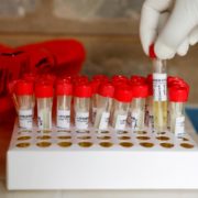 Виявлено новий симптом коронавірусу – “ковідні пальці”