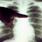 Лікар наочно показав шкоду антибіотиків для легень на початковій стадії COVID-19