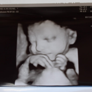 УЗД-апарат може зробити фото дитини ще до народження