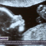Ембріон мав серце та деякі кістки: в Ізраїлі народилася дівчинка з близнюком у шлунку