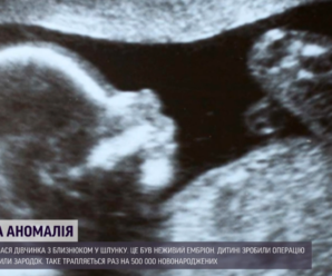 Ембріон мав серце та деякі кістки: в Ізраїлі народилася дівчинка з близнюком у шлунку