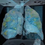 “Молоді легені перетворилися на “кашу”, штам “Дельта” почав завдавати інсульти”: лікарі про шаленство вірусу (ФОТО)