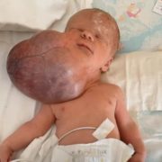 В Україні лікарі вперше видалили гігантську пухлину у немовляти, яка була вдвічі більша за голову